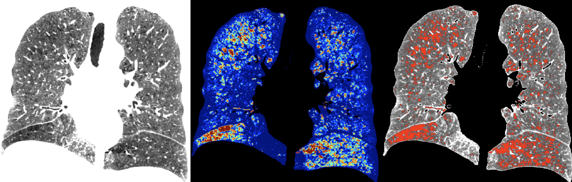 Emphysema Tracking 