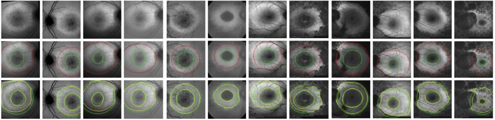Bayesian Transductive Markov Random Fields for Interactive Segmentation in Retinal Disorder